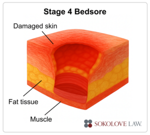 Stage 4 bedsore