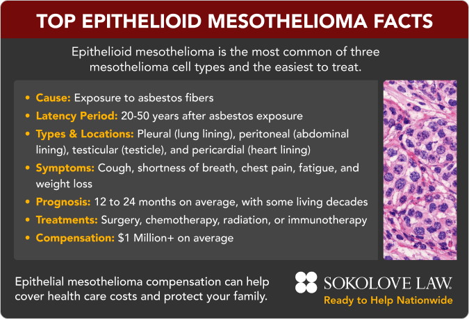 Epithelioid Mesothelioma Facts
