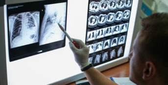 Doctor looks at lung x-rays