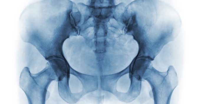 J&J Loses Sixth and Largest Pelvic Mesh Suit to Woman with Life-Altering Injuries