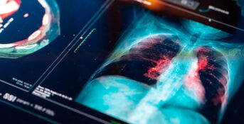 Lung x-rays