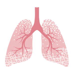 Asbestosis