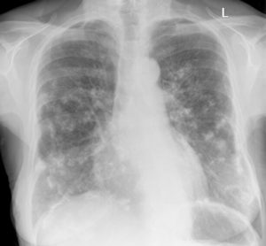 Asbestos related pleural plaques on chest x-ray