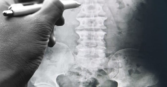 Low Back Pain: Spinal Cord Stimulators - Delaware Pain Management Doctors