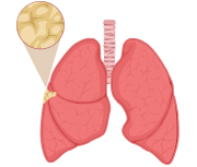 Stage 1 Mesothelioma Lungs