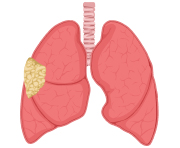 Stage 2 Mesothelioma Lungs