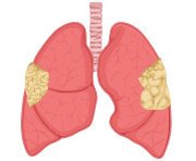 Stage 3 Mesothelioma Lungs