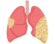 Stage 4 Mesothelioma Lungs