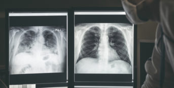 x-rays of the lungs