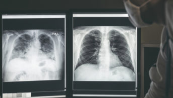 x-rays of the lungs