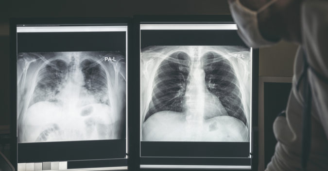 x-rays of the lungs